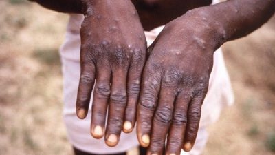 Negara-negara Afrika Laporkan Lebih dari 100 Kematian dalam Satu Minggu akibat Wabah Cacar Monyet