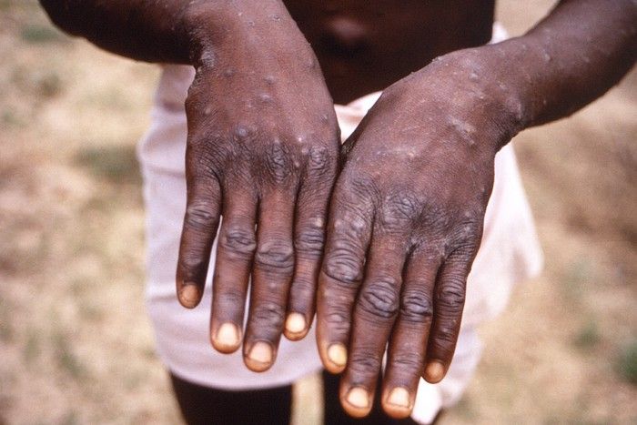 Gejala Monkeypox,, cacar