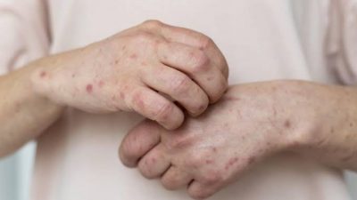 Patner Seksual Berisiko Terinfeksi Cacar Monyet