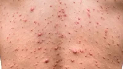 Cegah Cacar Monyet dengan Terapkan Pola Hidup Bersih